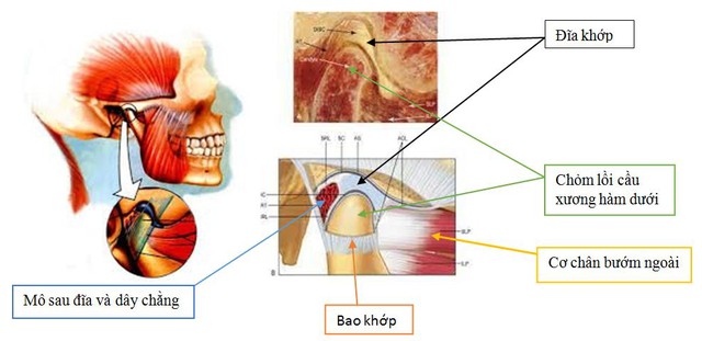 Rối loạn Khớp thái dương hàm là một hội chứng bao gồm một nhóm các triệu chứng như đau, tiếng kêu khớp, khó há miệng ở một bên hoặc hai bên vùng má, vùng thái dương.