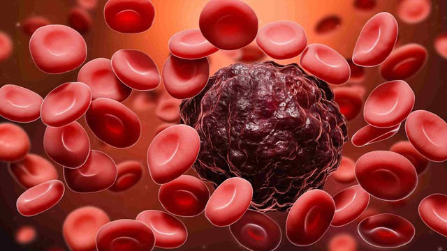 Ung thư máu: Nguyên nhân, dấu hiệu và cách điều trị  - Ảnh 3.