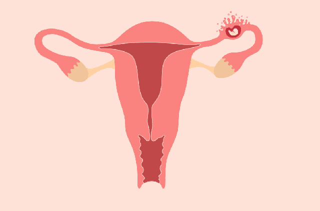 Cẩn trọng khi dùng thuốc phá thai nhưng không biết chửa ngoài tử cung - Ảnh 2.