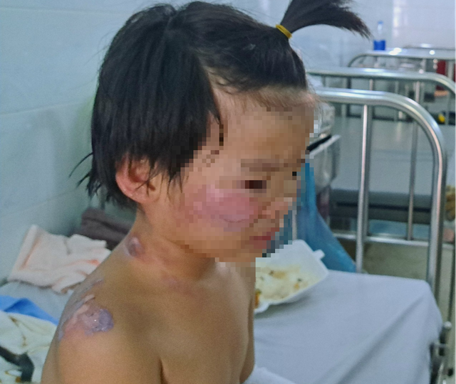 4 trẻ trong vụ cháy nhà khi bố mẹ vắng nhà ở Tây Ninh hiện ra sao? - Ảnh 1.