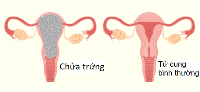 Chửa trứng có gây ung thư không? - Ảnh 2.