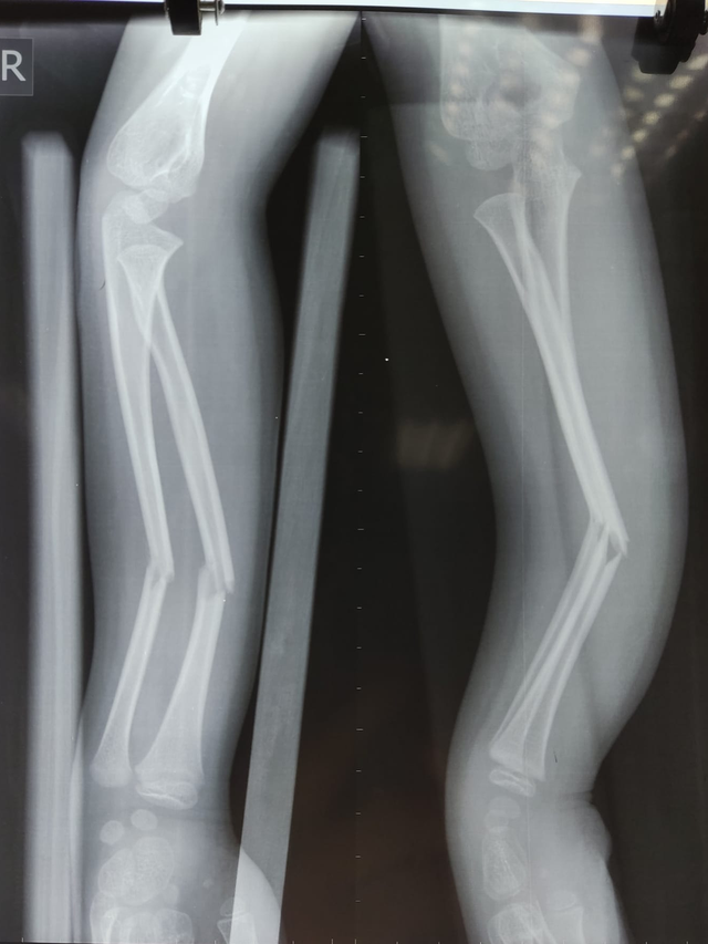 Phẫu thuật kết hợp xương dưới màn hình tăng sáng cứu bé 7 tuổi bị gãy 2 xương cẳng tay

 - Ảnh 1.