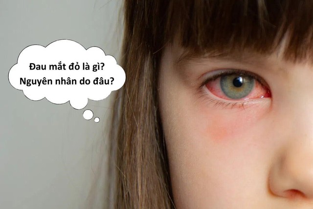 Đau mắt đỏ dùng thuốc gì? Những lưu ý khi sử dụng thuốc trị đau mắt đỏ - Ảnh 1.