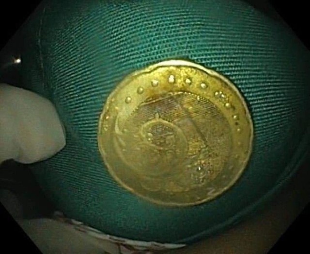 Đồng xu mắc kẹt trong thực quản của bé gái 5 tuổi - Ảnh 2.