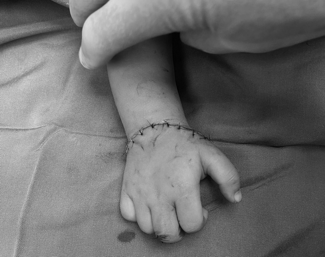 Phẫu thuật nối liền thành công bàn tay bị đứt rời cho bệnh nhi gần 18 tháng tuổi - Ảnh 2.