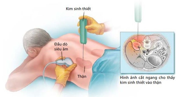 Sinh thiết thận là một phương pháp quan trọng để chẩn đoán bệnh thận, hiện nay sinh thiết thận đã trở thành một kỹ thuật thăm dò thận phổ biến và thường quy.