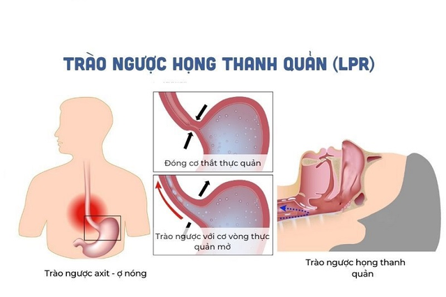 Lý giải nguyên nhân ho, viêm họng do trào ngược dạ dày- Ảnh 1.