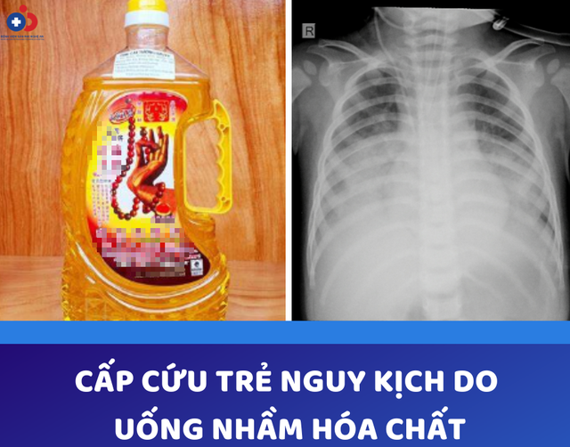 Uống dầu thắp đèn, một trẻ tím tái phải thở máy- Ảnh 1.