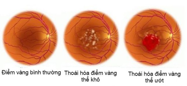 Đáy mắt là thuật ngữ y khoa chung nhằm để phân vùng một cách chính xác vị trí 2 cấu trúc có liên hệ mật thiết với nhau ở sâu trong nhãn cầu, đó là dịch kính & võng mạc.