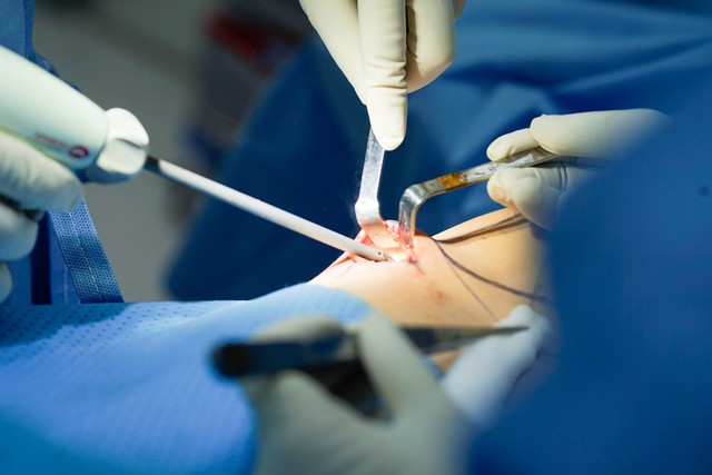 Tiên phong ứng dụng thế hệ dao Ultrasonic surgical scalpel trong phẫu thuật nâng ngực- Ảnh 1.