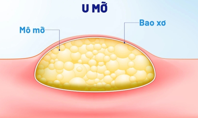 U mỡ là hiện tượng tăng sinh mô mỡ tích tụ dưới da tuy không ảnh hưởng nhiều đến sức khỏe nhưng gây mất thẩm mỹ nếu xuất hiện ở cổ, cánh tay, trán.