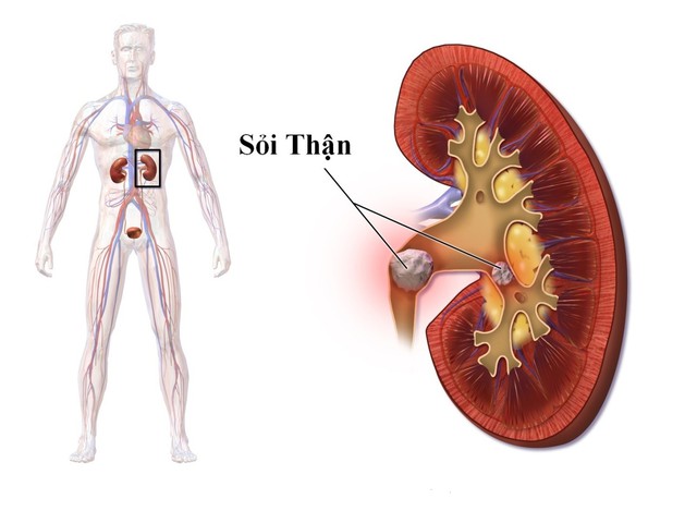 Ăn thực phẩm chứa oxalat có gây sỏi thận không?- Ảnh 1.