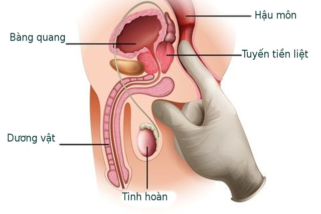 Các câu hỏi liên quan đến bệnh viêm tuyến tiền liệt- Ảnh 1.