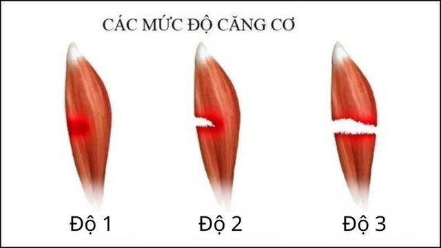 Căng cơ quá mức: Nguyên nhân, triệu chứng, cách điều trị và phòng tránh- Ảnh 3.