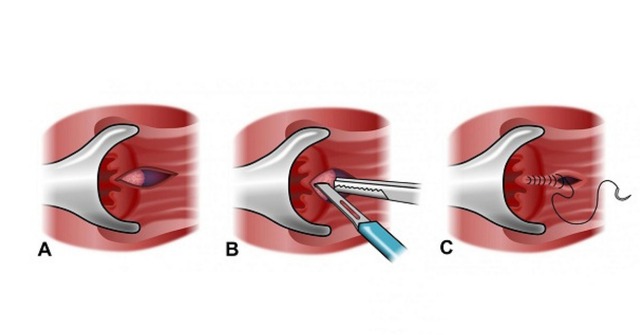 Thuốc và các phương pháp điều trị nứt kẽ hậu môn- Ảnh 4.