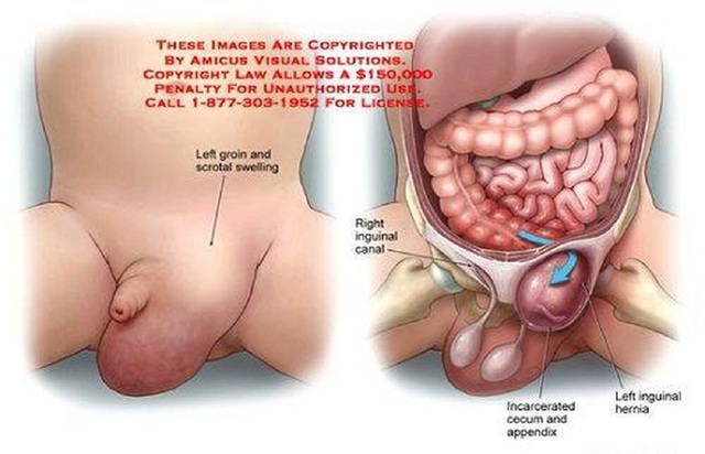 Chế độ dinh dưỡng cho trẻ em bị thoát vị bẹn- Ảnh 3.