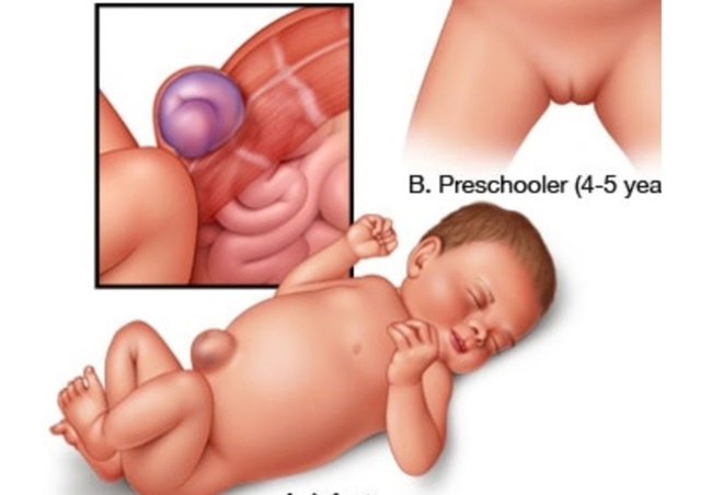 Thoát vị rốn: Nguyên nhân, triệu chứng, cách điều trị và phòng bệnh- Ảnh 1.