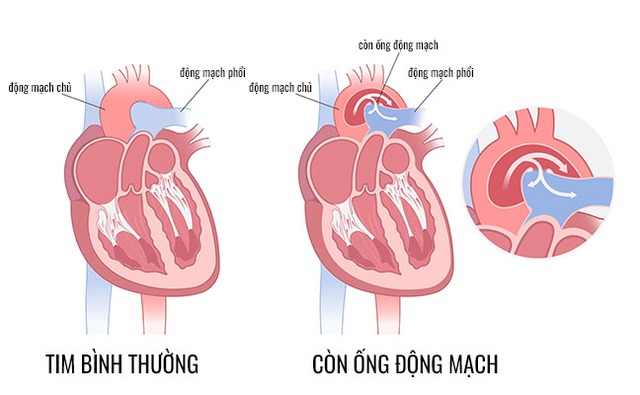 Câu hỏi thường gặp về còn ống động mạch- Ảnh 2.