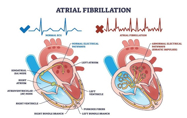 Rối loạn nhịp tim: tìm hiểu những rủi ro tiềm ẩn- Ảnh 1.