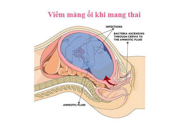 Bệnh viêm màng ối: Nguyên nhân, triệu chứng, phòng bệnh và cách điều trị- Ảnh 4.