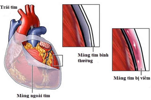 Viêm màng ngoài tim co thắt: Nguyên nhân, triệu chứng, phòng bệnh và cách điều trị- Ảnh 1.