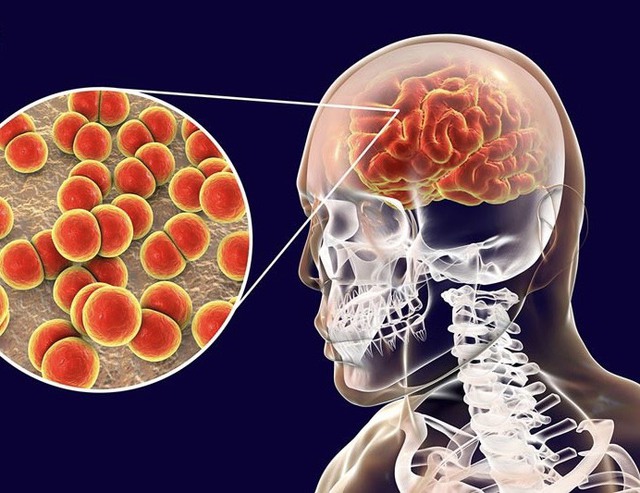 Viêm màng não do não mô cầu: Nguyên nhân, triệu chứng cách điều trị và phòng bệnh- Ảnh 1.