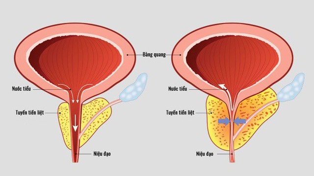 Dấu hiệu cảnh báo nam giới đang gặp vấn đề tuyến tiền liệt- Ảnh 1.