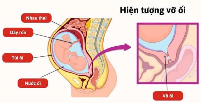 Vỡ ối non: Nguyên nhân, triệu chứng, cách điều trị và phòng bệnh- Ảnh 1.