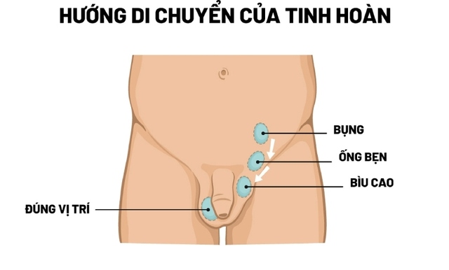 Bệnh tinh hoàn ẩn: Nguyên nhân, triệu chứng, phòng bệnh và điều trị- Ảnh 1.