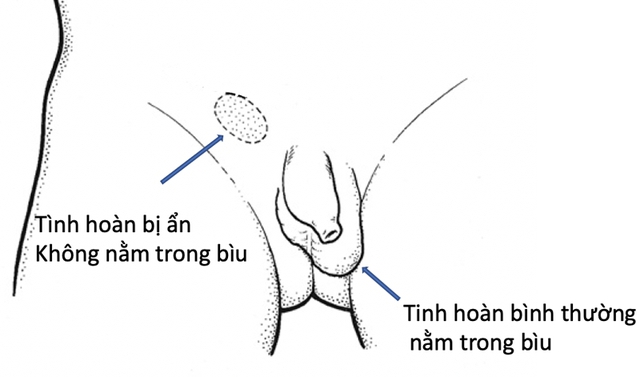 Câu hỏi thường gặp liên quan đến bệnh tinh hoàn ẩn- Ảnh 1.