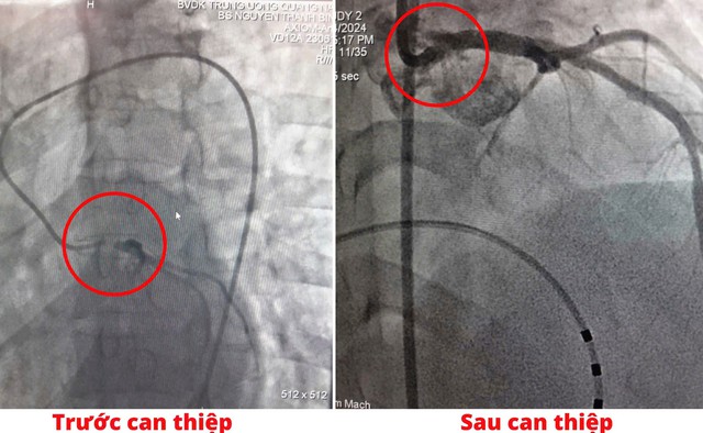 Đến bệnh viện điều trị viêm dạ dày thực quản trào ngược, bất ngờ lên cơn nhồi máu cơ tim rất nặng- Ảnh 1.