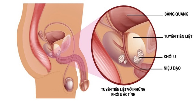 Khi nào nam giới nên tầm soát ung thư tuyến tiền liệt?- Ảnh 1.