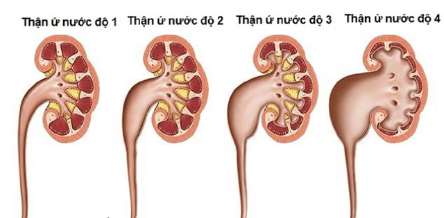 Thận ứ nước: Nguyên nhân, triệu chứng và cách điều trị- Ảnh 2.