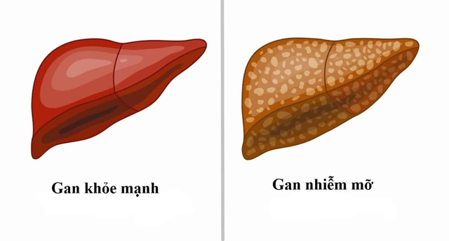 Cân bằng chuyển hóa – bảo vệ sức khỏe của gan- Ảnh 1.