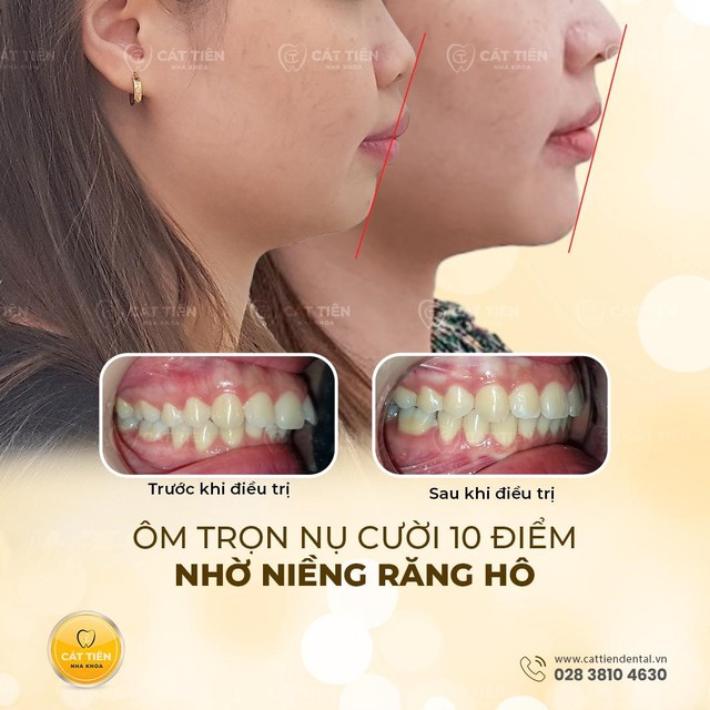 Niềng răng đúng để có nụ cười khỏe mạnh, thẩm mỹ- Ảnh 1.