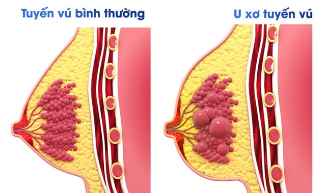 U xơ tuyến vú có dẫn đến ung thư vú không?- Ảnh 1.