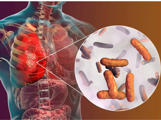 Chẩn đoán đồng nhiễm lao trên bệnh nhân HIV- Ảnh 3.