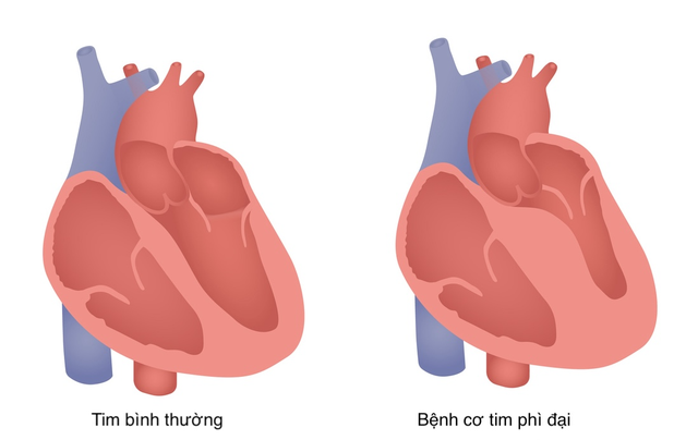 Bơm cồn sinh học cứu sống bệnh nhân bị bệnh cơ tim phì đại nặng- Ảnh 2.