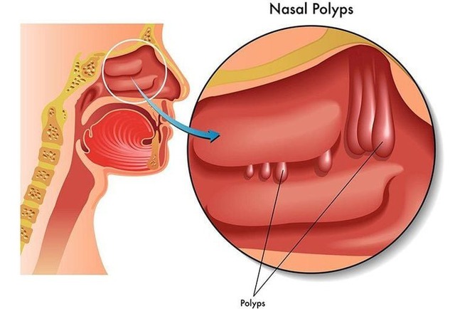 Thuốc và phương pháp điều trị polyp mũi- Ảnh 1.