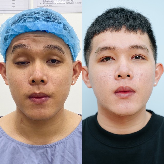 Giám đốc Y khoa BonBoZ Clinic giúp chàng trai nhược cơ mí nặng tự tin với diện mạo mới- Ảnh 2.