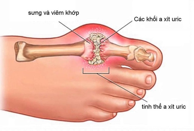 Để bệnh gout không tiến triển nặng, người bênh cần duy trì chế độ dinh dưỡng khoa học, đầy đủ các vitamin cũng như khoáng chất, kiểm soát được lượng chất nạp vào trong cơ thể. Ảnh minh họa