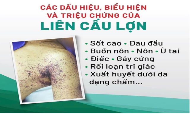 Sốt cao, đau nhức cơ, đi khám phát hiện mắc liên cầu lợn- Ảnh 1.