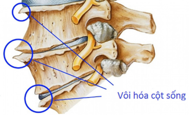 Bài tập tốt cho người bệnh vôi hoá cột sống- Ảnh 1.