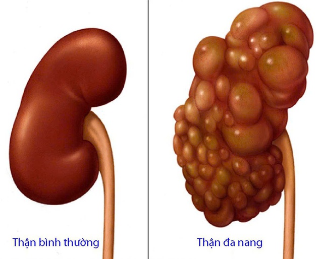 Thận đa nang: Nguyên nhân, triệu chứng, cách điều trị và phòng bệnh- Ảnh 2.