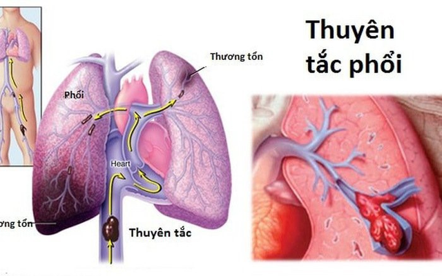 Người bị thuyên tắc phổi nên ăn, uống gì?- Ảnh 1.