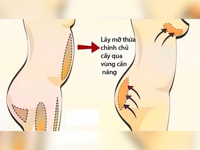 Hiểu rõ về tình trạng mỡ teo sau khi cấy vào cơ thể- Ảnh 1.