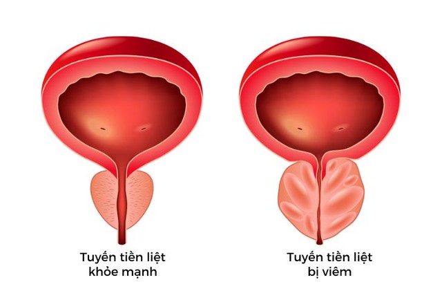 4 loại viêm tuyến tiền liệt phổ biến ở nam giới- Ảnh 1.