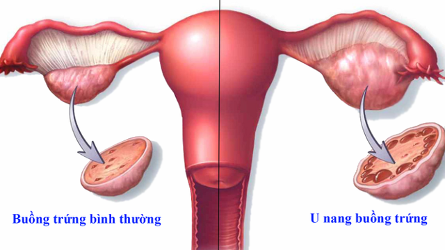 Bị u nang buồng trứng nên ăn gì và kiêng gì?- Ảnh 1.