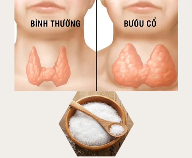 Tìm hiểu về bệnh bướu cổ và biện pháp cải thiện- Ảnh 1.