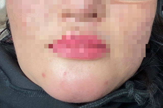 Tiêm filler cằm, một phụ nữ bị chảy dịch mủ trong miệng- Ảnh 1.